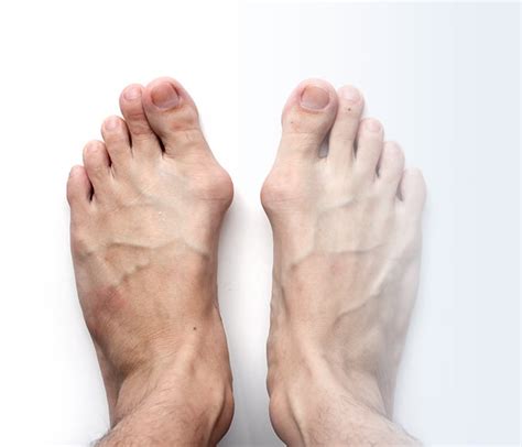 Buy Orthotics for Bunions Online in India | Insoles for Bunions