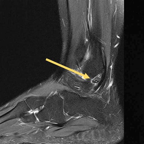 Neoplasien von Sehnen, Sehnenscheiden, Bändern und Faszien – ein Überb ...