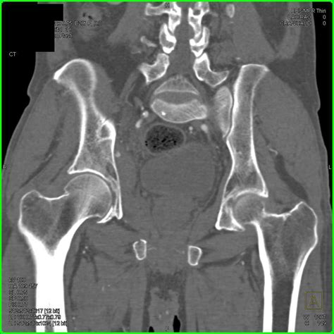 Right Hip Joint Effusion and Normal CTA - Musculoskeletal Radiology ...