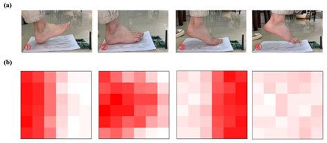 Plantar Pressure Detection System Based on Flexible Hydrogel Sensor ...