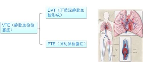 院内VTE防控体系——住院病人的有效安全保护网 - 医疗动态 - 信息公开 - 郑州大学第五附属医院