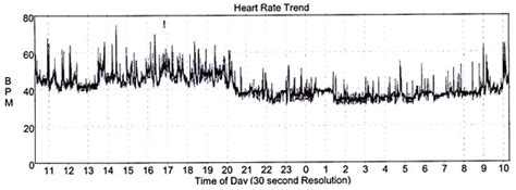 Management of Complete Heart Block in a Pregnant Woman with Systemic ...