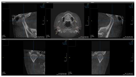 Evaluation of Cortical Bone Formation on Mandibular Condyle in ...
