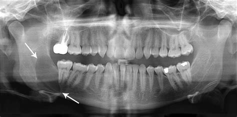 Oral Pathology: Distinguishing Cysts From Abscesses - Today's RDH