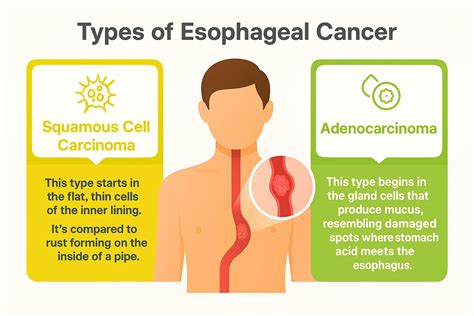 Esophageal Cancer: Symptoms, Causes, and Treatment Options