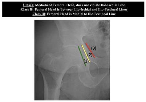 Pectineal Line Of Femur