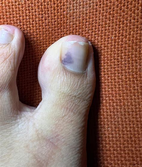 So here's the dark "bruise" under my toe nail. I kinda noticed it moved? : r/Melanoma
