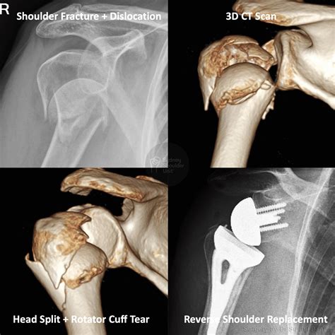 Shoulder Fracture with Dislocation | Medical Case Study | Sydney ...