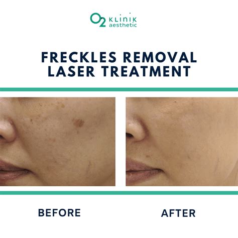 How to Get Rid of Freckles with Laser Treatment | O2 Klinik Aesthetic