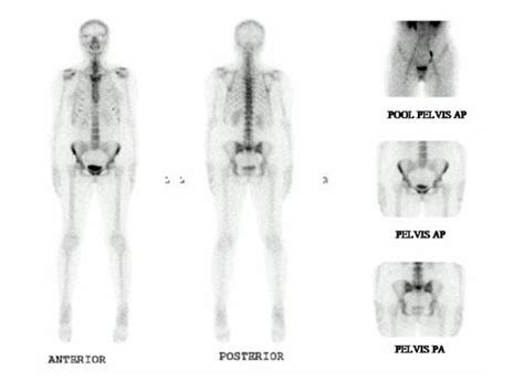 Image result for Normal Bone Scan