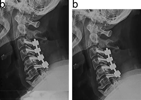 Anterior decompression and posterior total laminectomy with fusion for ossification of the ...
