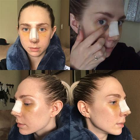 Nose Job: Surgery, Recovery, Cast Removal & Two Week Post-Op Reveal | Until The Very Trend Nose ...
