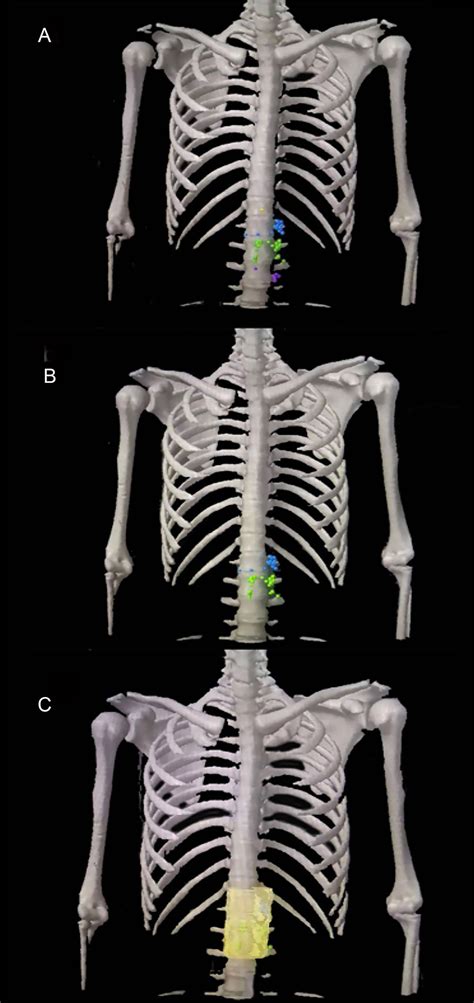 Frontiers | Recommendations of the clinical target volume for the para-aortic region based on ...