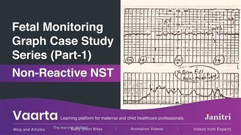 Fetal Monitoring Graph Case Study Series – Part 1