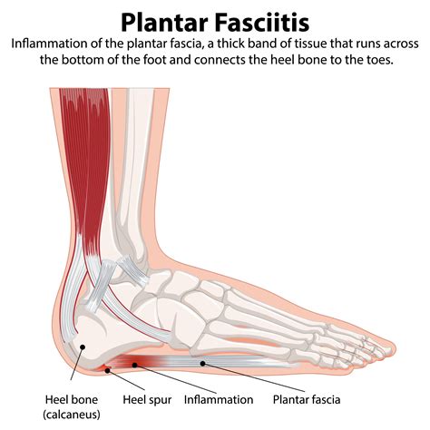 Shockwave Therapy for Plantar Fasciitis - Effective Relief for Heel Pain
