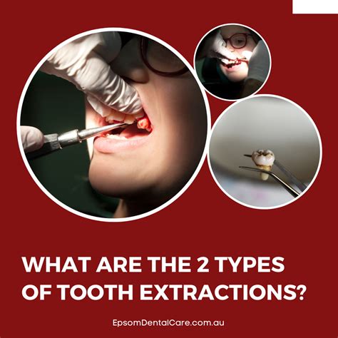 What Are The 2 Types of Tooth Extractions? in 2025 | Tooth extraction, Surgical tooth extraction ...