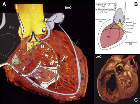 Heart Ablation Diagram at Audrey Wethington blog