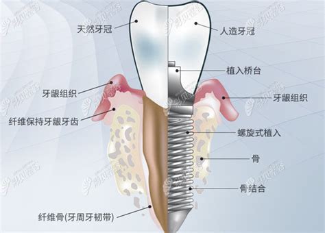 Implant Surgical Guide-Shenzhen Palmary Medical technology co.,Ltd.
