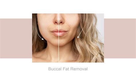 Buccal Fat Removal
