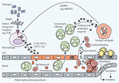 Community-acquired bacterial meningitis - The Lancet