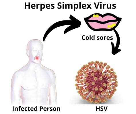 Image result for Simplex Virus 2