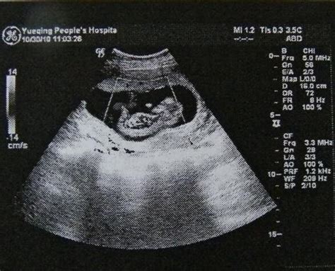 孕11周起要做的NT检查，准妈妈不要错过的第一次排畸 - 知乎