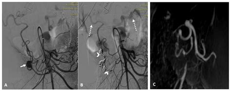 Is Celiac Trunk Revascularization Necessary after High-Flow ...