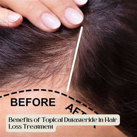 Topical Dutasteride: A New Approach to Hair Loss Treatment | Clinikally