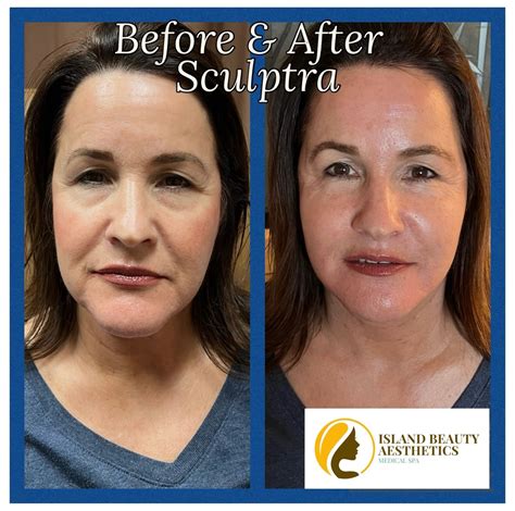 Island Beauty Aesthetics - Sculptra Treatment, Sculptra Injections, Sculptra Fillers