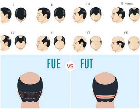 FUE vs FUT Hair Transplant- Estenove