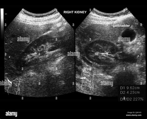 Normal Kidney Ultrasound