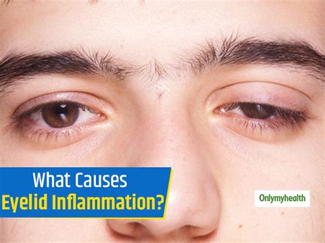 What Makes Eyelid Swell? Know The 5 Major Causes Of Eyelid Inflammation ...