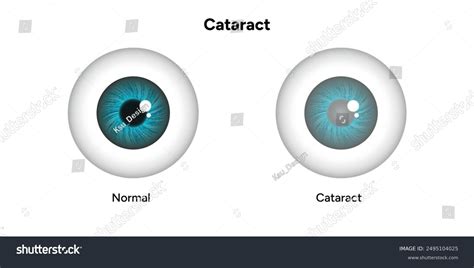 Vision Disorder 的图像结果