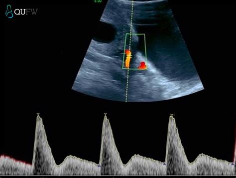 Nuchal Translucency / Early Anatomy / Pre-eclampsia Screening - QUFW