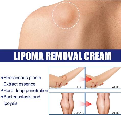 Lipoma Removal Cream 0.7oz | Anti-Inflammatory Cellulite Treatment for Skin | Easy Absorption ...