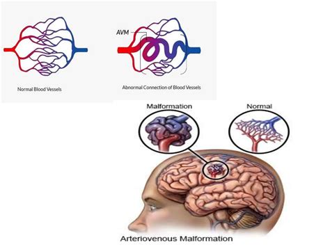 Image result for CVA Recovery