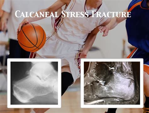 Heel Stress Fracture - Robert Sheinberg, DPM | Weston, FL Podiatrist