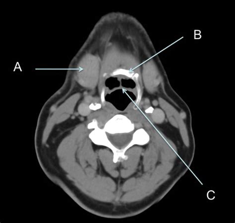 Ct Soft Tissue Neck Anatomy Head And Neck Imaging | Radiology Key