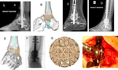 Use of Three-dimensional Titanium Trusses for Arthrodesis Procedures in Foot and Ankle Surgery ...