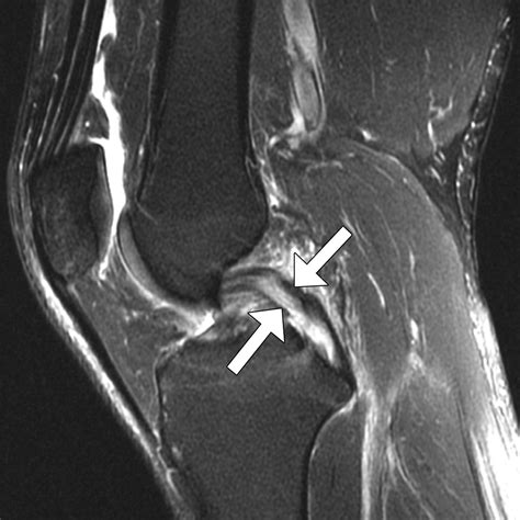 Posterior Cruciate Ligament Mri Tunnelless Anatomic Arthroscopic