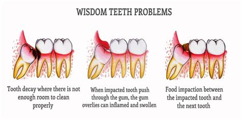 Remove Wisdom Teeth With Deivam Dental Clinic - Health, Beauty ...