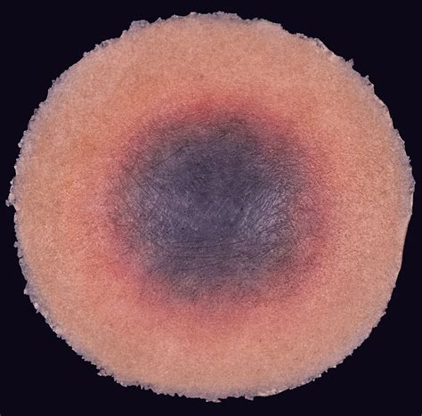 Image result for Deep Tissue Injuries