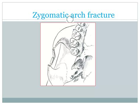 Zygomatic Complex Fracture- ZMC | PPTX