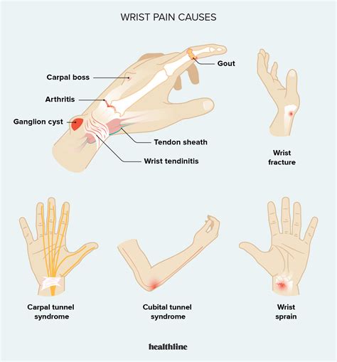 Possible causes of wrist pain and treatment tips – Artofit