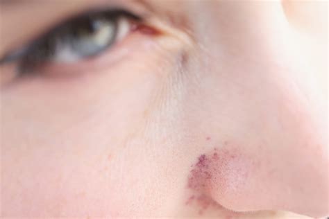 ANCA-Associated Vasculitis Prognosis - Rare Disease Advisor