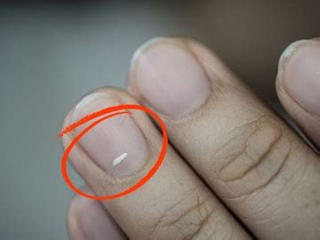 કેલ્શિયમ નહીં,શરીરમાં આ વસ્તુની ખામીના કારણે નખ પર હોય છે સફેદ ડાઘ ...