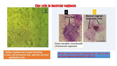 Bacterial vaginosis: Introduction, clue cell significance and Amsel ...