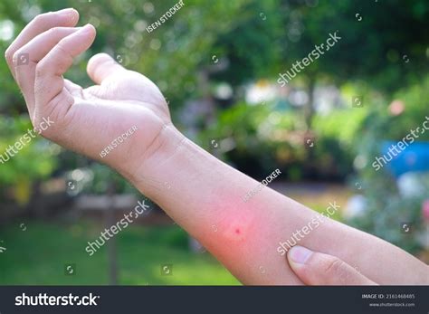 Swollen Mosquito Bite