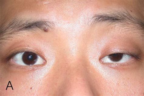 Image result for Levator Resection Surgery