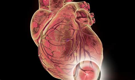 ECMO linked with increased bleeding risk among patients with ...